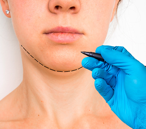 Equilibre su rostro con una mentoplastia en Bogotá Paciente que le hacen marcación para mentoplastia en Bogotá